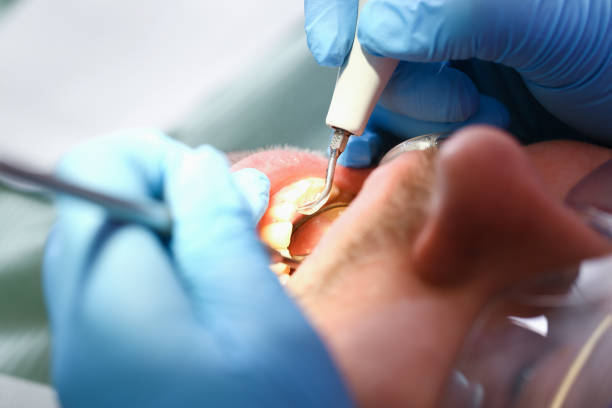 Best Emergency Dentist for Knocked-Out Tooth in Angola, NY