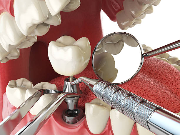 Best Emergency Dentist for Lost Fillings or Crowns in Angola, NY
